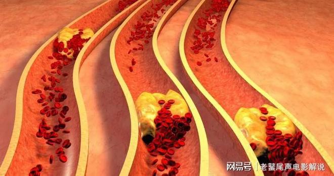 马上停止5类运动很可能加速血栓形成!等血管“堵死”就迟了(图2)