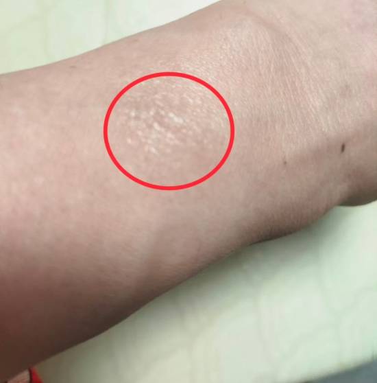 第一批戴运动手环的“受害者”出现了：手腕发白粗糙真凶却不是绿光